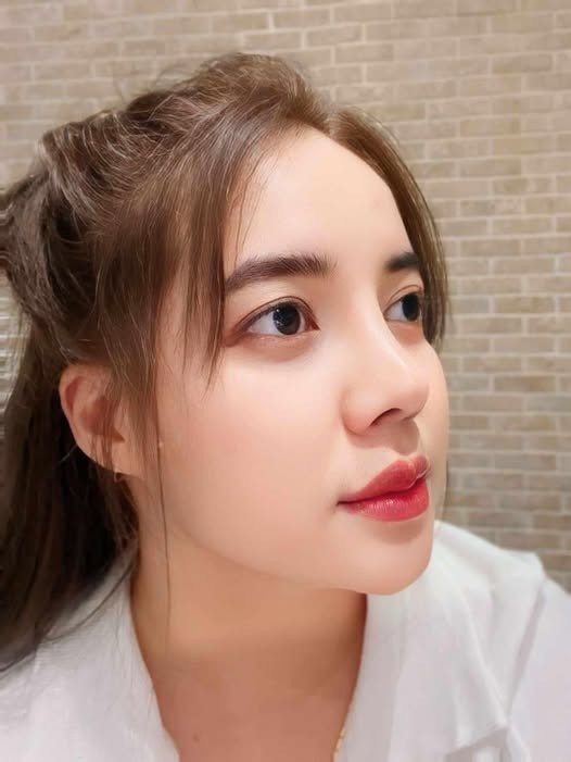 Thời gian tốt nhất đánh giá dáng mũi sau nâng?