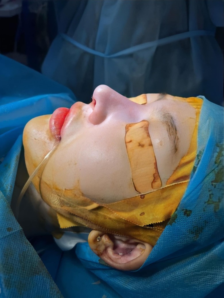 Cách giảm sưng bầm sau nâng?