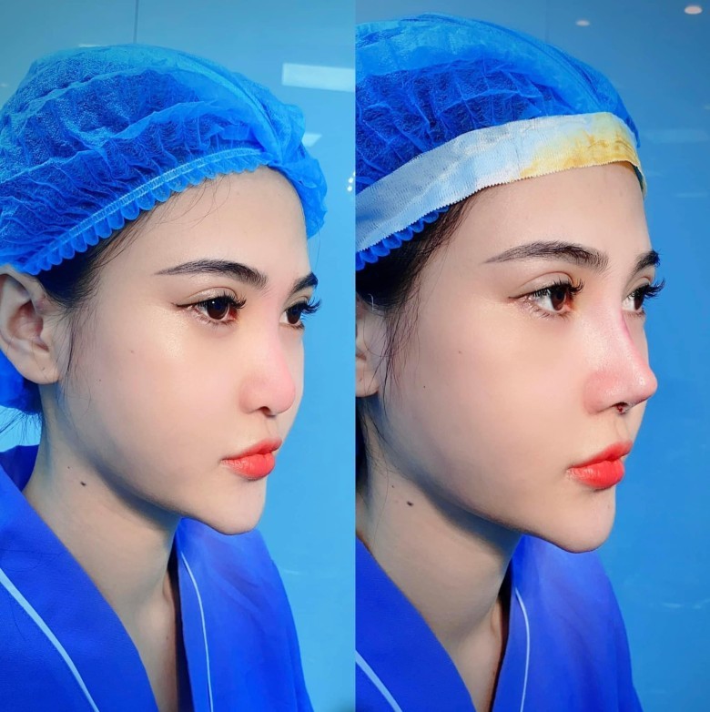 Đối tượng không nên nâng mũi phẫu thuật?