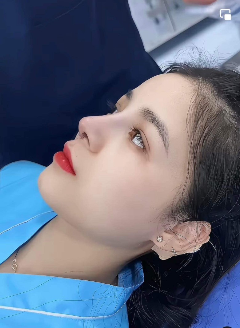 Sau nâng mũi nên kiêng gì trong 1–2 tuần đầu?