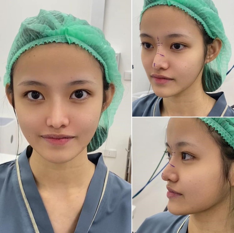 Khi nào nên chỉnh sửa mũi sau phẫu thuật (nếu cần)?