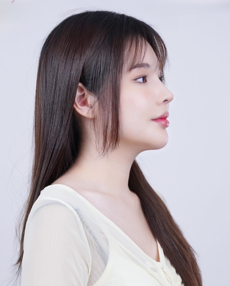 Nguyên nhân phổ biến khiến mũi sau nâng bị lệch?