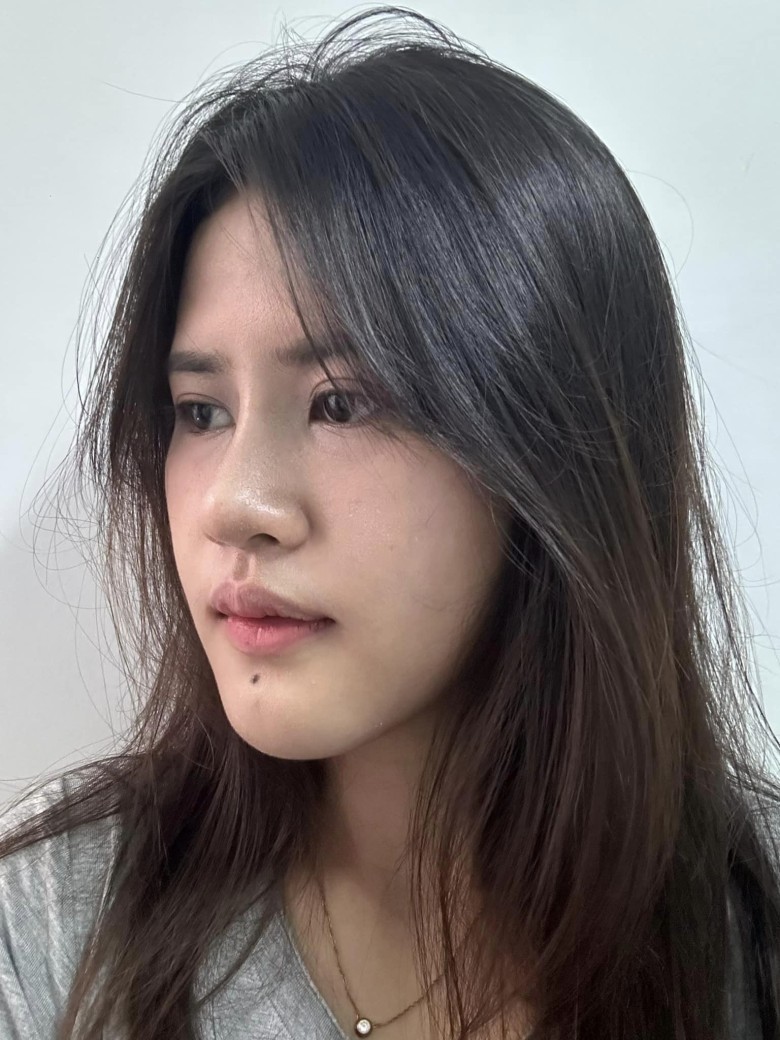 Tại sao cần chuẩn bị tâm lý trước nâng mũi?