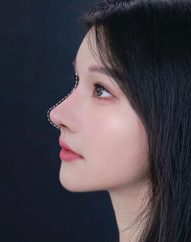 Ưu điểm của nâng mũi bọc sụn?