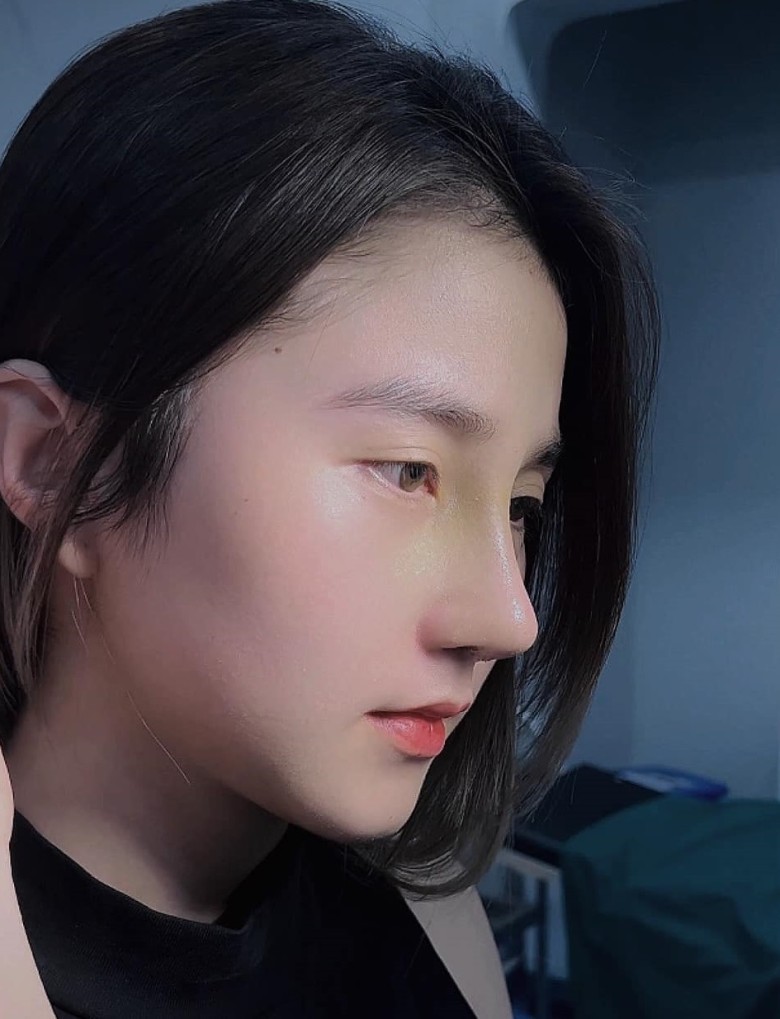 Ưu điểm khi sử dụng sụn tai nâng mũi?