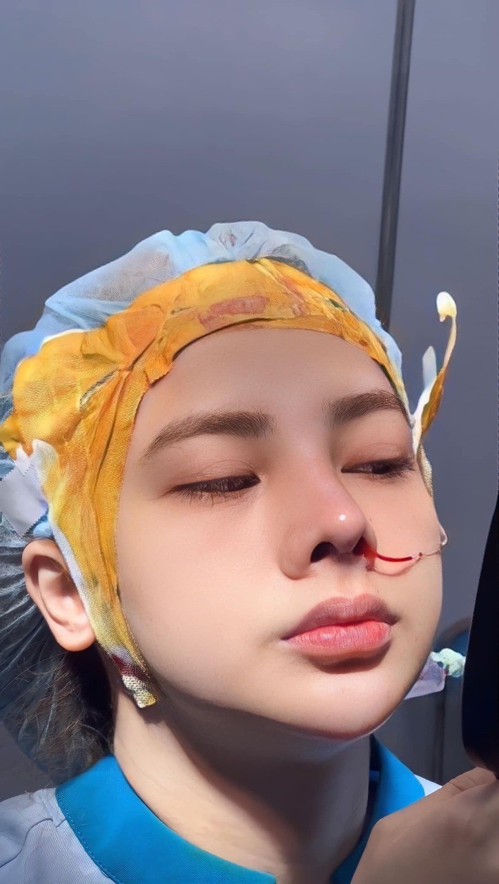 Sau nâng mũi nên tránh gì?