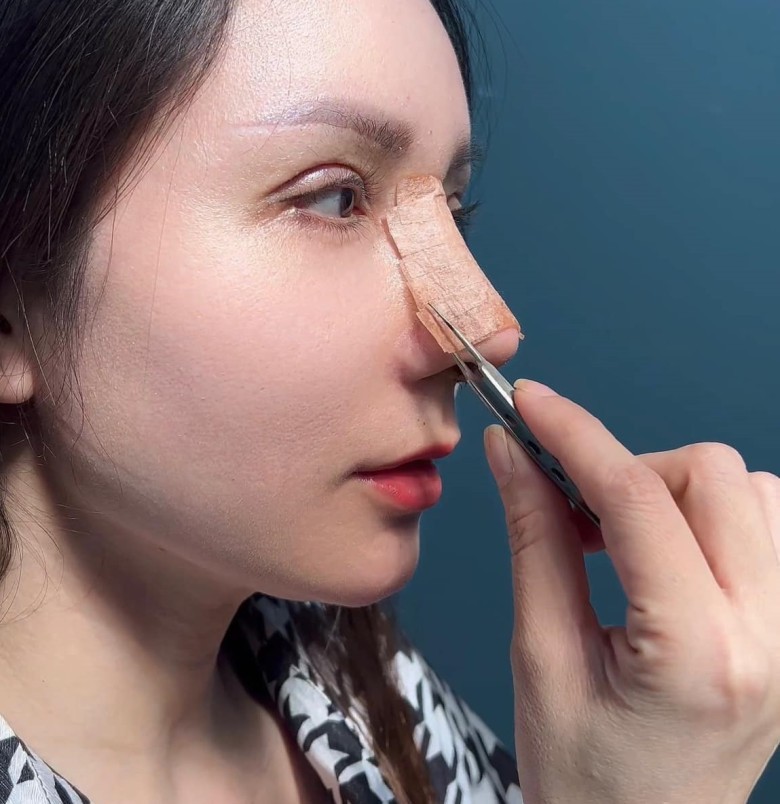 Khi nào nên tập thể dục sau nâng mũi?