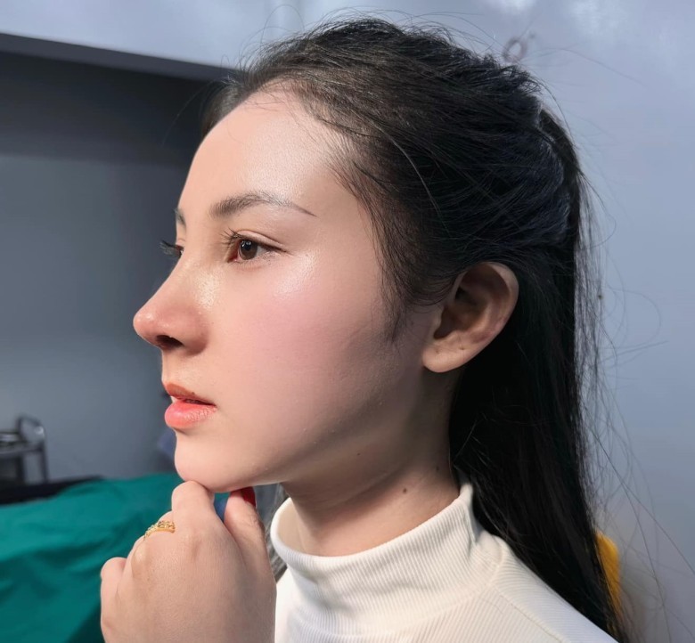 Làm sao giảm nguy cơ lộ sống mũi?