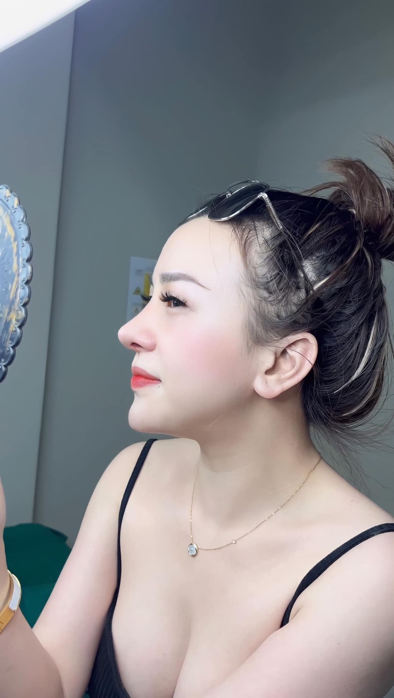 Nguyên nhân thường gặp khiến sống mũi lệch?