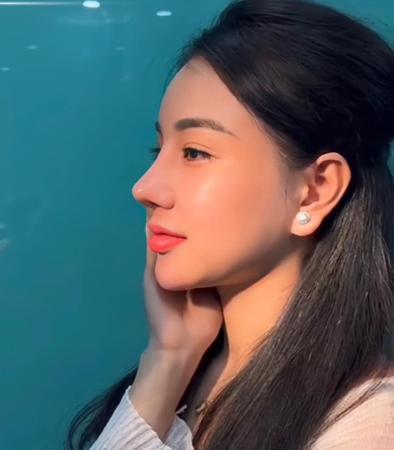 Sưng lâu sau nâng mũi khi nào cần đi bác sĩ?