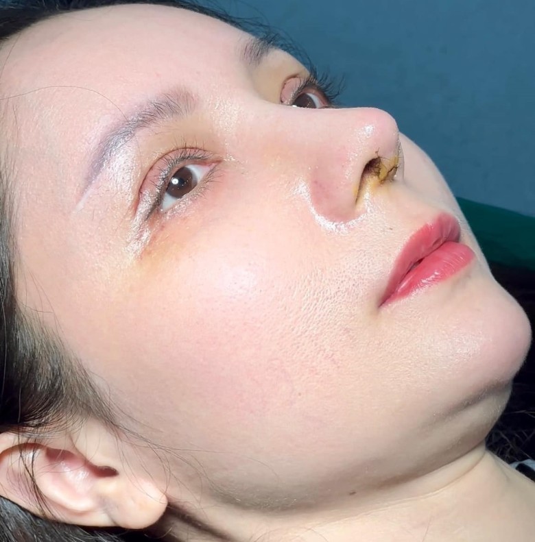 Khi nào nên kết hợp nâng mũi và điều chỉnh trán?