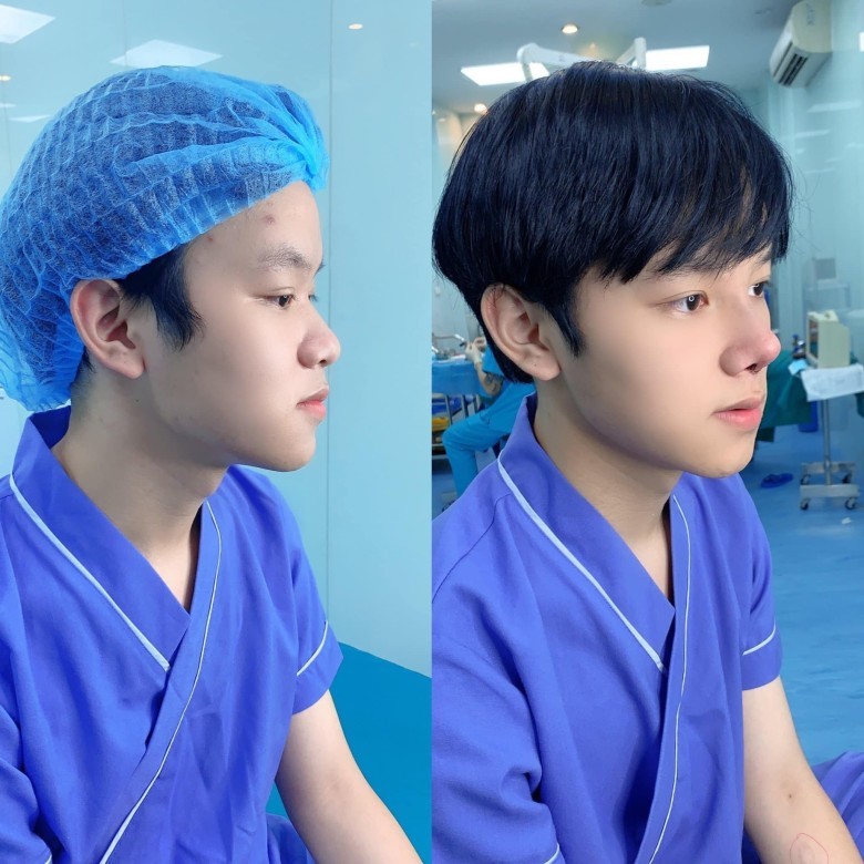 Đặc điểm mũi nam tính?