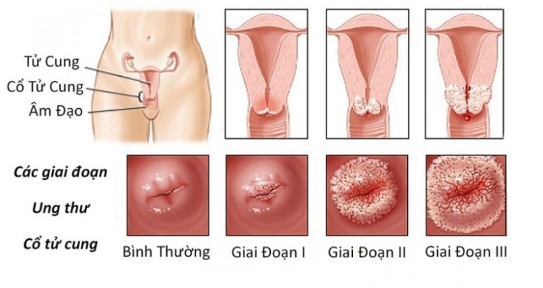 Nguyên nhân chính gây ung thư cổ tử cung là gì?