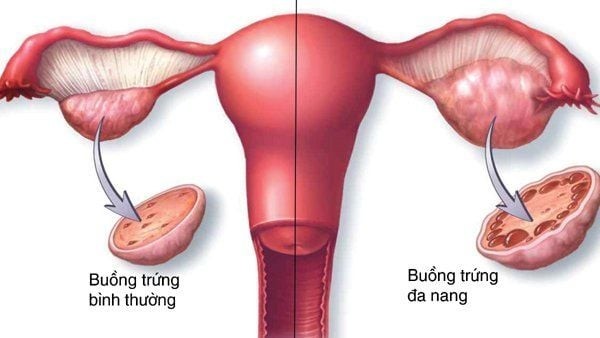 Dấu hiệu đặc trưng nhất của buồng trứng đa nang là gì?