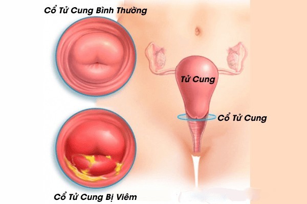 Nguyên nhân nào thường gây viêm cổ tử cung?