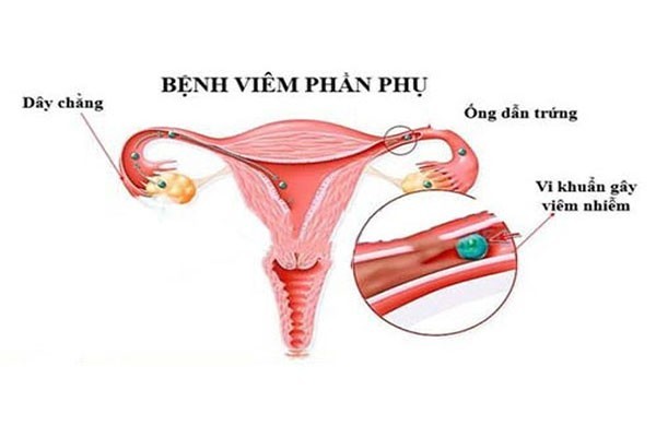 Triệu chứng phổ biến của viêm phần phụ là gì?