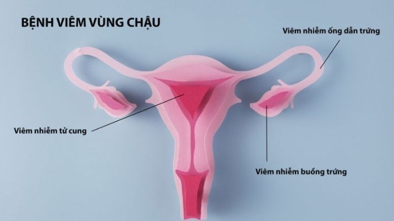 Nguyên nhân nào dễ dẫn đến viêm vùng chậu?