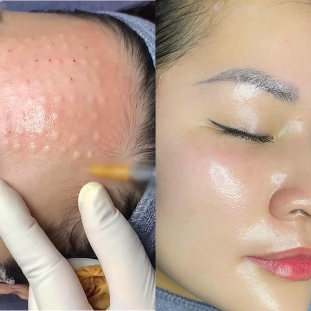 Ai KHÔNG nên tiêm Meso?