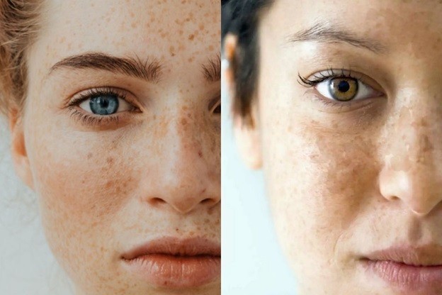 Vì sao PRP có thể hỗ trợ điều trị nám?