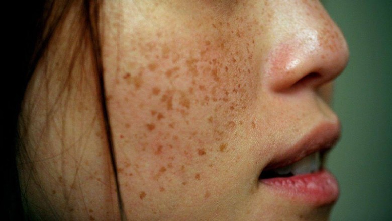 Ưu điểm nổi bật của IPL so với Laser là gì?