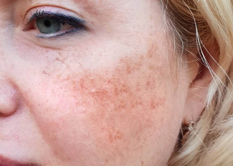 Vì sao PicoSure hiệu quả hơn Laser truyền thống?