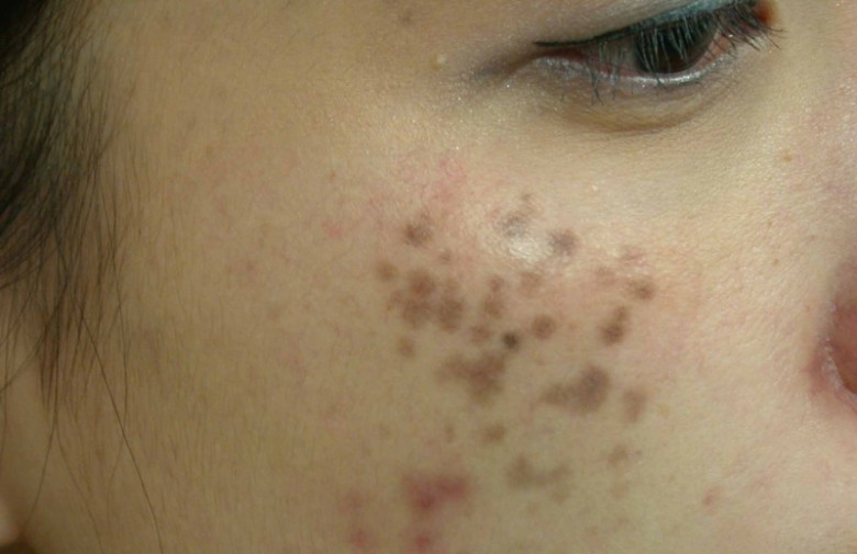 Ưu điểm lớn nhất của việc kết hợp Peel + Laser là gì?