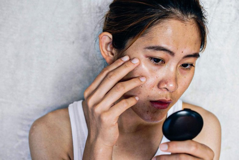 Vì sao cần điều trị kết hợp nám và tàn nhang cùng lúc?