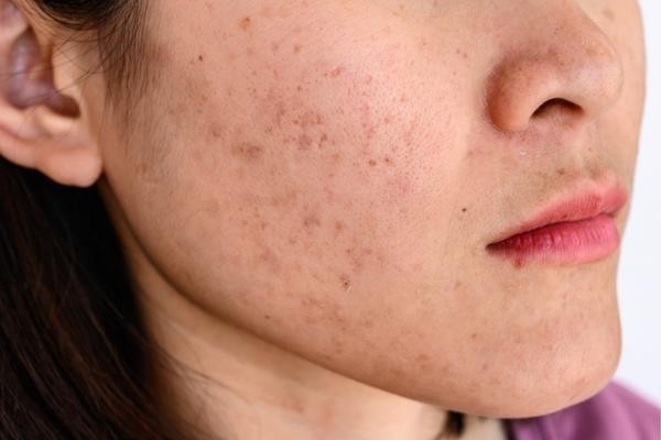 Tại sao kem trộn dễ gây nám?