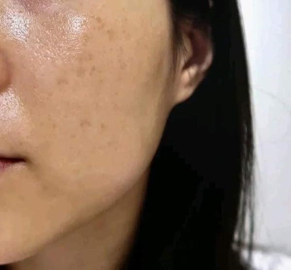 Ưu điểm nổi bật của Laser Toning là gì?