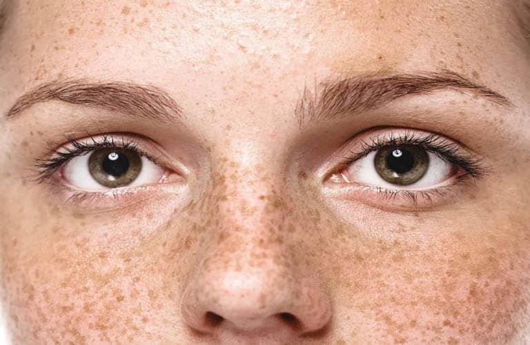 Meso Therapy có ưu điểm gì?