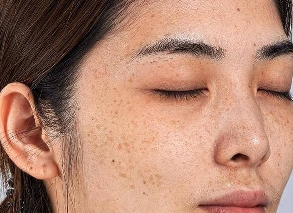 Niacinamide trị nám nhờ cơ chế nào?