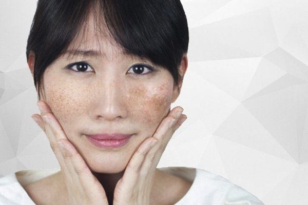 Glutathione giúp trị nám bằng cách nào?