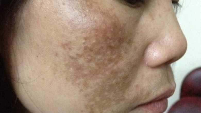 HIFU giúp trị nám và trẻ hóa bằng cơ chế nào?