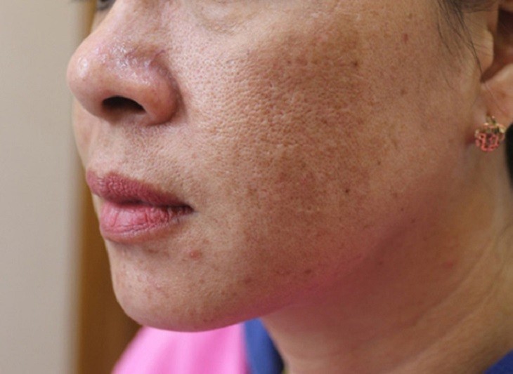 Vì sao cần phác đồ trị nám toàn diện?