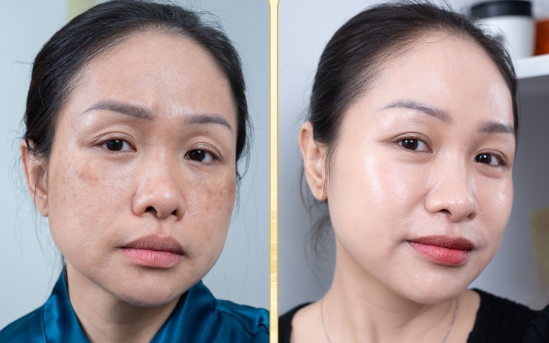 Laser Pico tác động chủ yếu vào đâu?