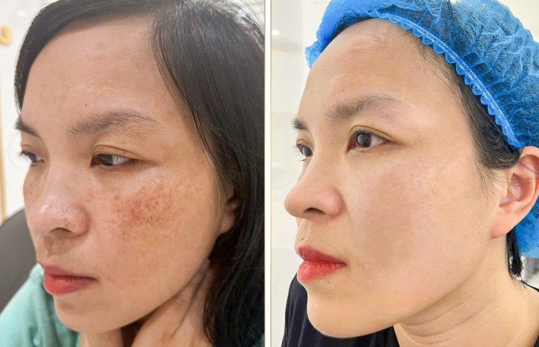 Peeling hoạt chất giúp trị nám nhờ cơ chế nào?