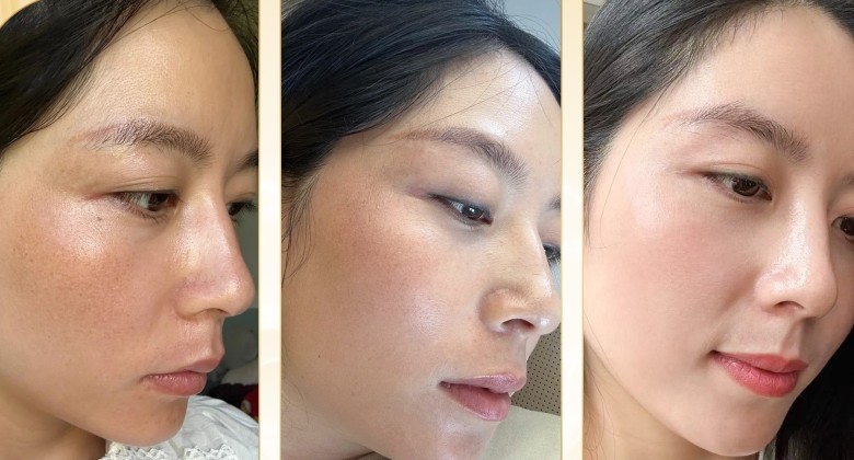 Phác đồ 6 bước giúp trị nám toàn diện nhờ yếu tố nào?