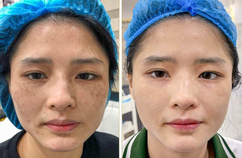 Niacinamide giúp trị nám bằng cơ chế nào?