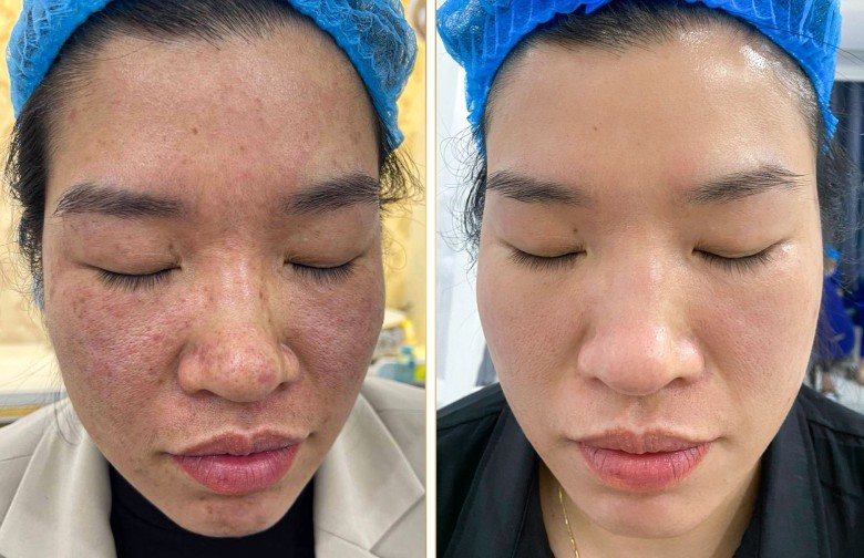 Axit Hyaluronic kết hợp Meso giúp gì cho da nám?