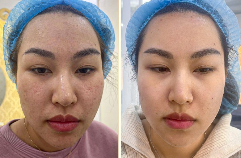 Laser Fractional CO2 tác động vào đâu để trị nám hiệu quả?