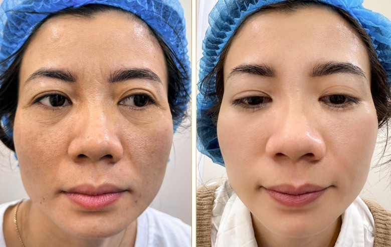 Phương pháp Meso Therapy kết hợp Laser giúp trị nám nhờ cơ chế nào?