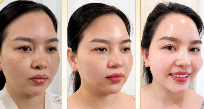 Vitamin C kết hợp Peeling giúp trị nám nhờ cơ chế nào?