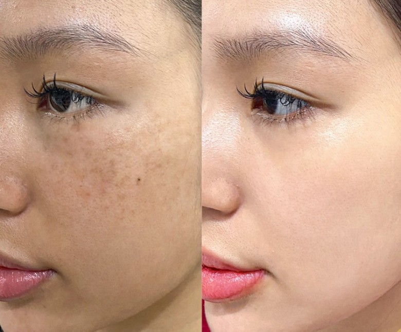 Niacinamide kết hợp Collagen giúp trị nám nhờ cơ chế nào?