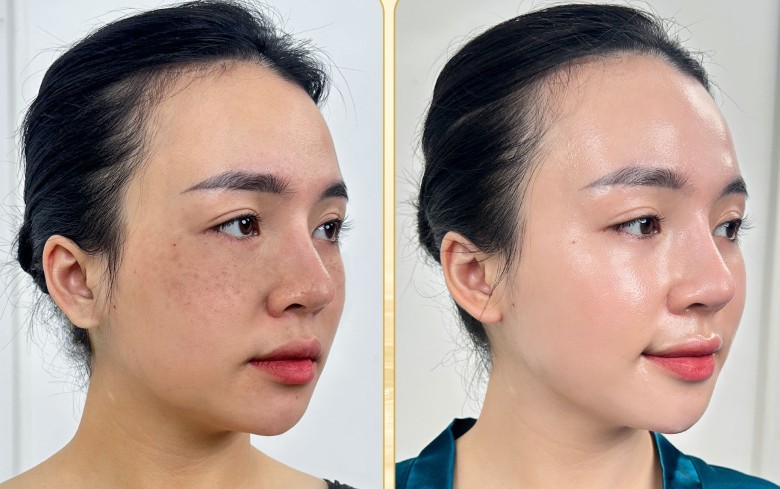 Bạn nghĩ nguyên nhân chính gây nám mảng là gì?