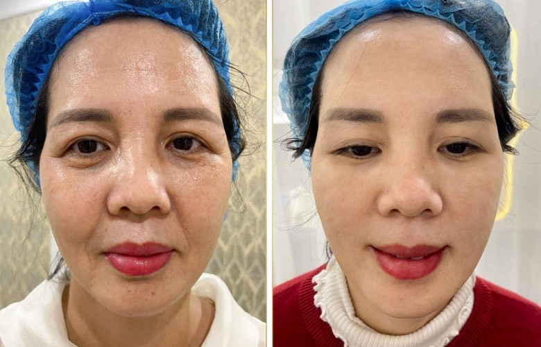 Bạn nghĩ nguyên nhân chính gây nám chân sâu là gì?