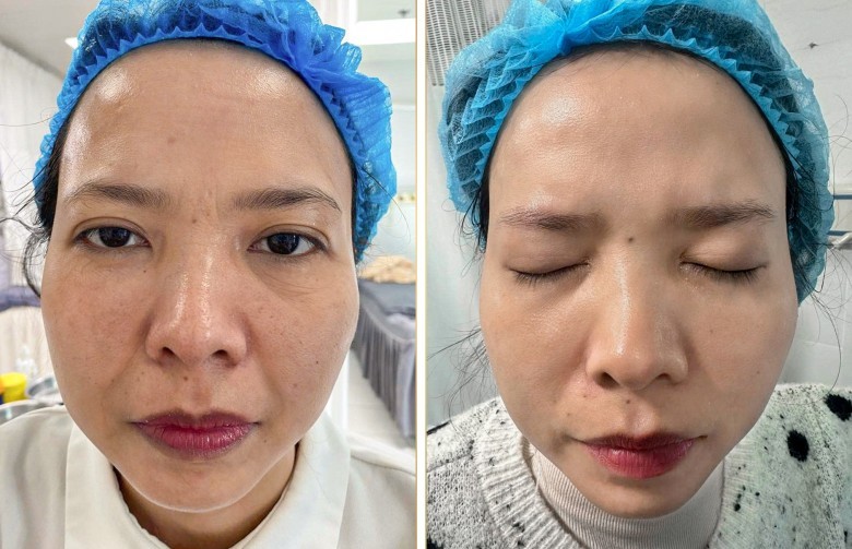 Bạn nghĩ nguyên nhân chính gây nám nội tiết là gì?
