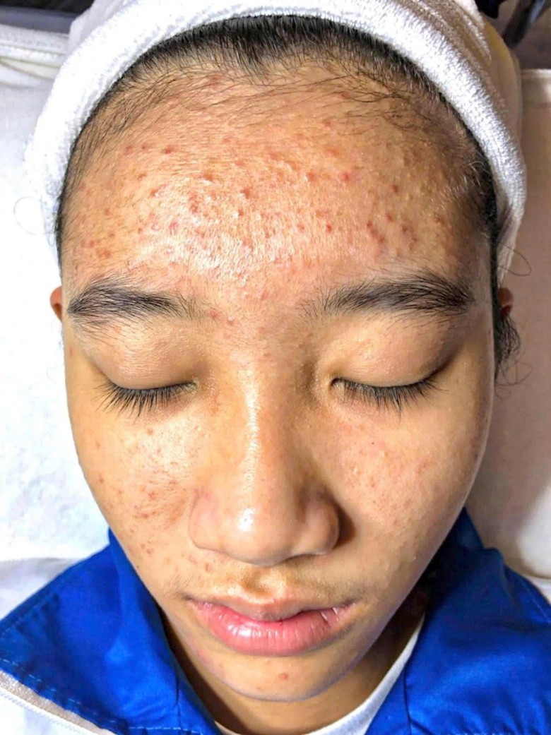 Bạn thường làm gì khi gặp mụn viêm?