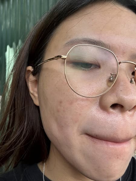 Bạn thường xử lý mụn ẩn thế nào?
