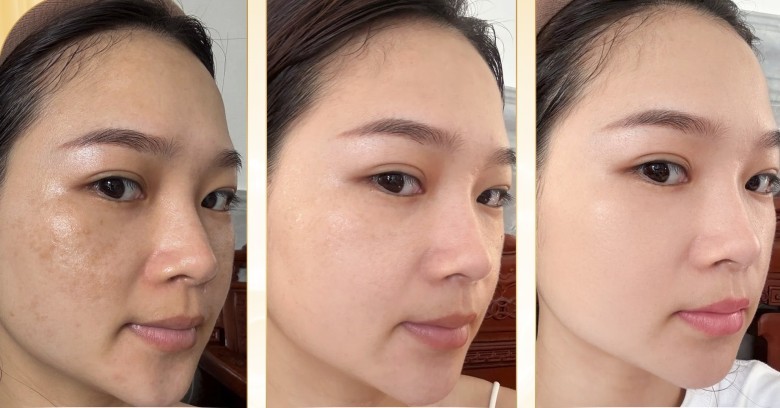 Bạn nghĩ nguyên nhân chính gây nám hỗn hợp là gì?