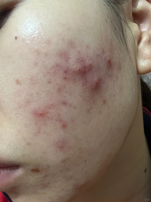 Nguyên nhân chính gây mụn tuổi dậy thì?